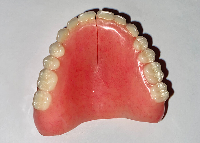 Cracked Denture